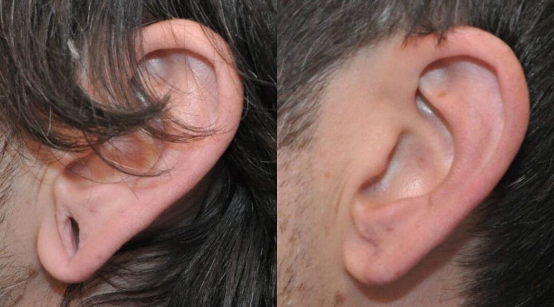 Earlobe Repair #3