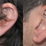 Earlobe Repair #3 - Before and After