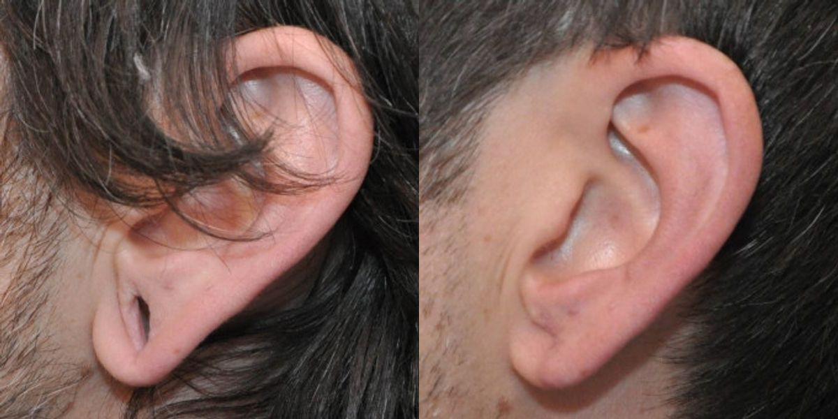 Earlobe Repair #3 - Before and After