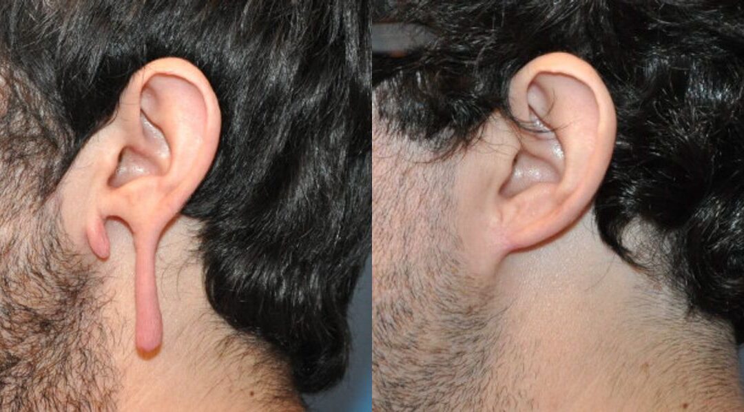 Earlobe Repair #4