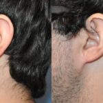 Earlobe Repair #4 - Before and After