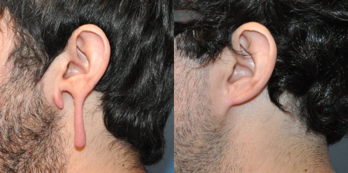 Earlobe Repair #4 - Before and After