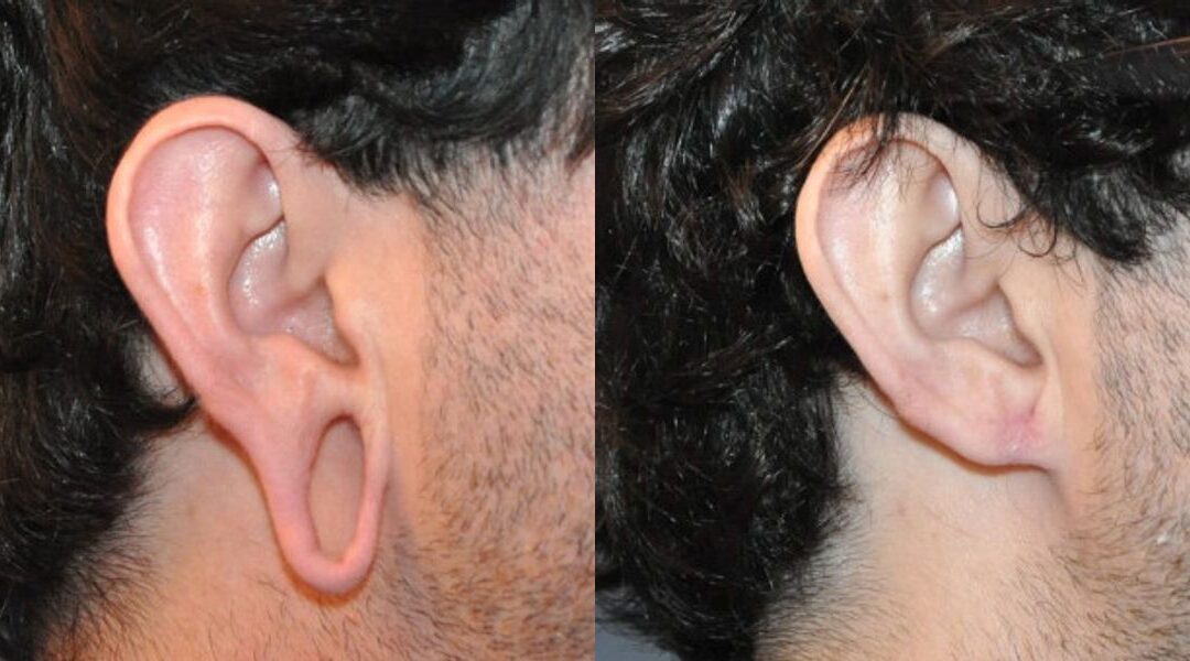 Earlobe Repair #5