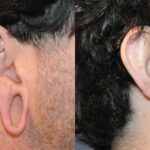 Earlobe Repair #5 - Before and After