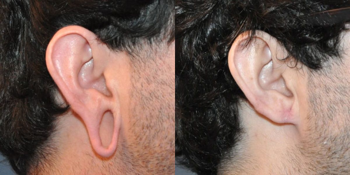 Earlobe Repair #5 - Before and After