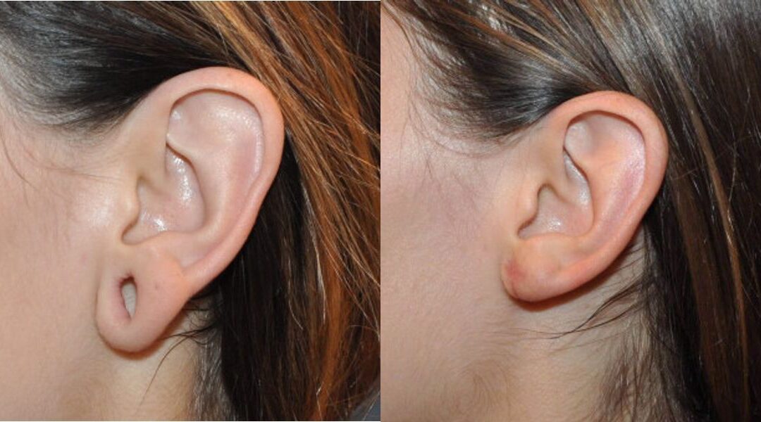 Earlobe Repair #6