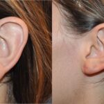 Earlobe Repair #6 - Before and After