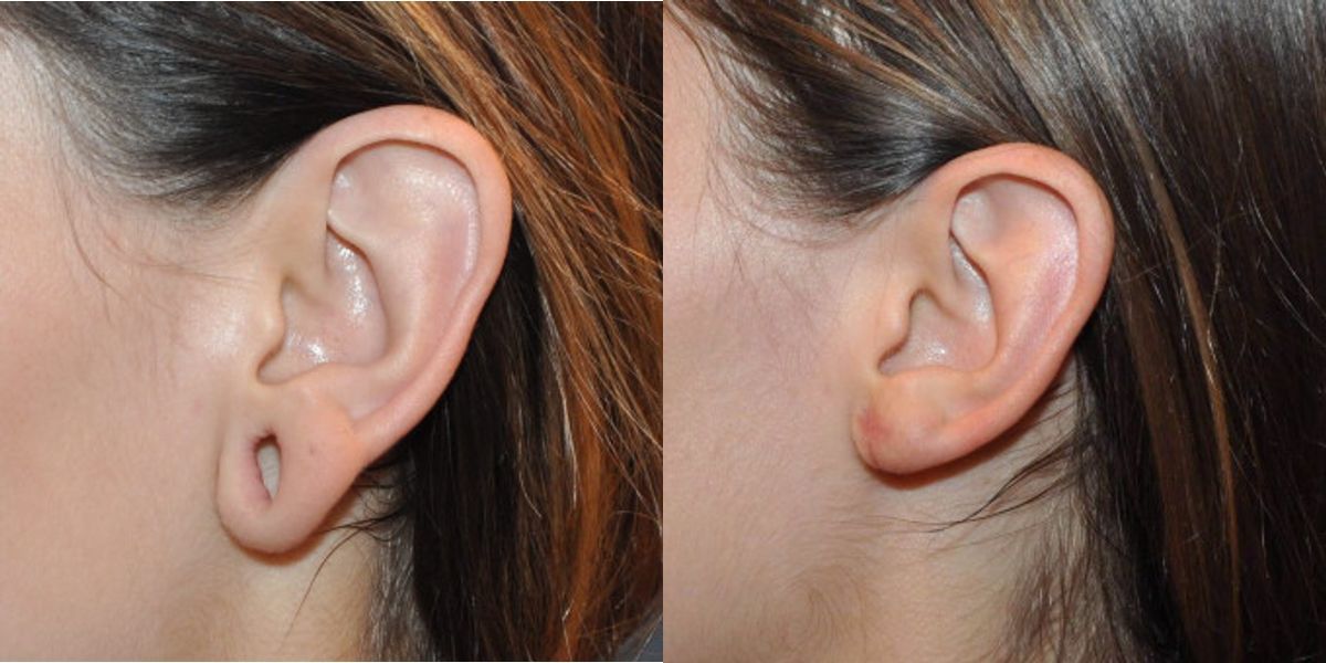 Earlobe Repair #6 - Before and After