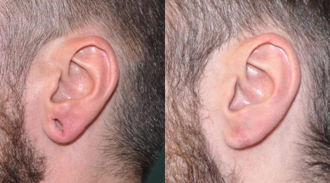 Earlobe Repair #7