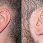 Earlobe Repair #7 - Before and After