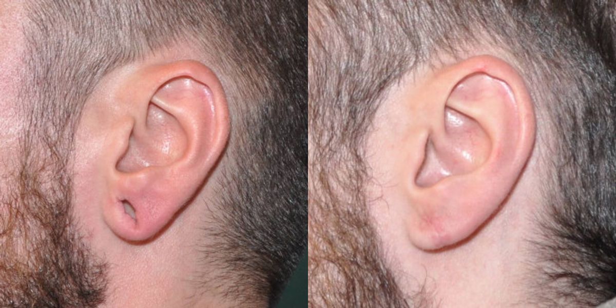 Earlobe Repair #7 - Before and After