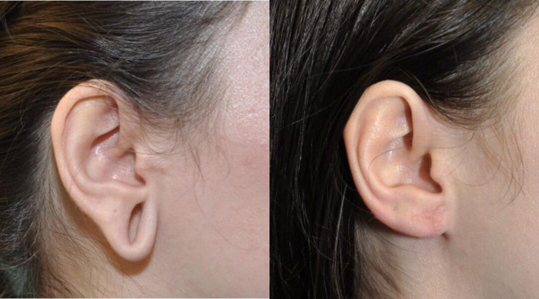 Earlobe Repair #8