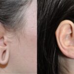 Earlobe Repair #8 - Before and After