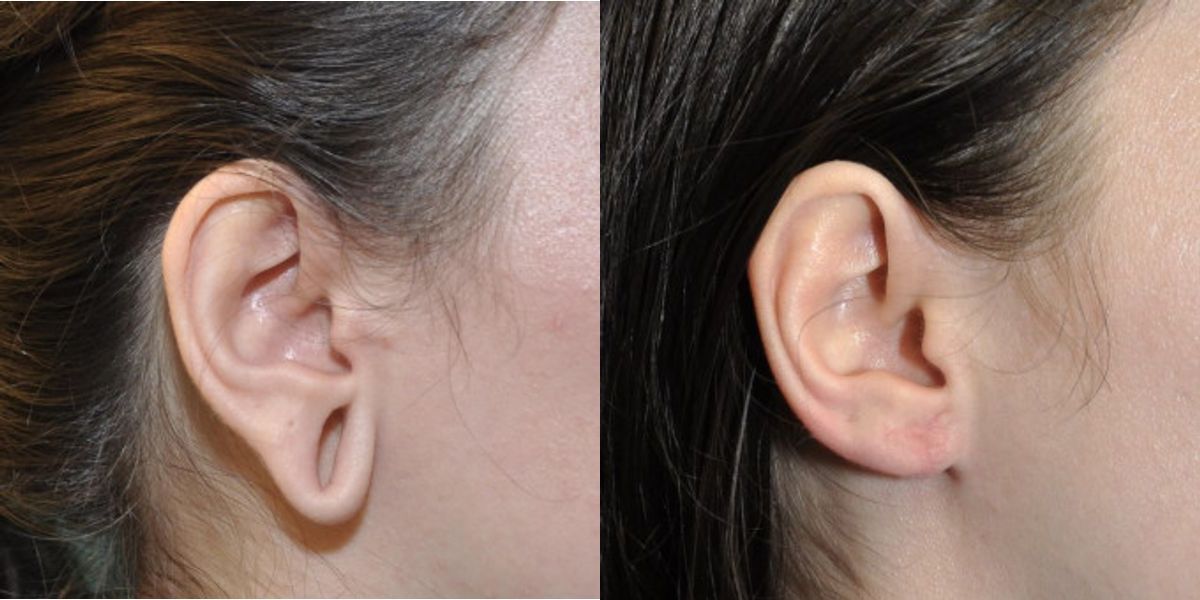 Earlobe Repair #8 - Before and After