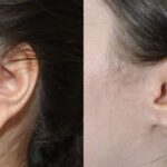 Earlobe Repair #8 - Before and After