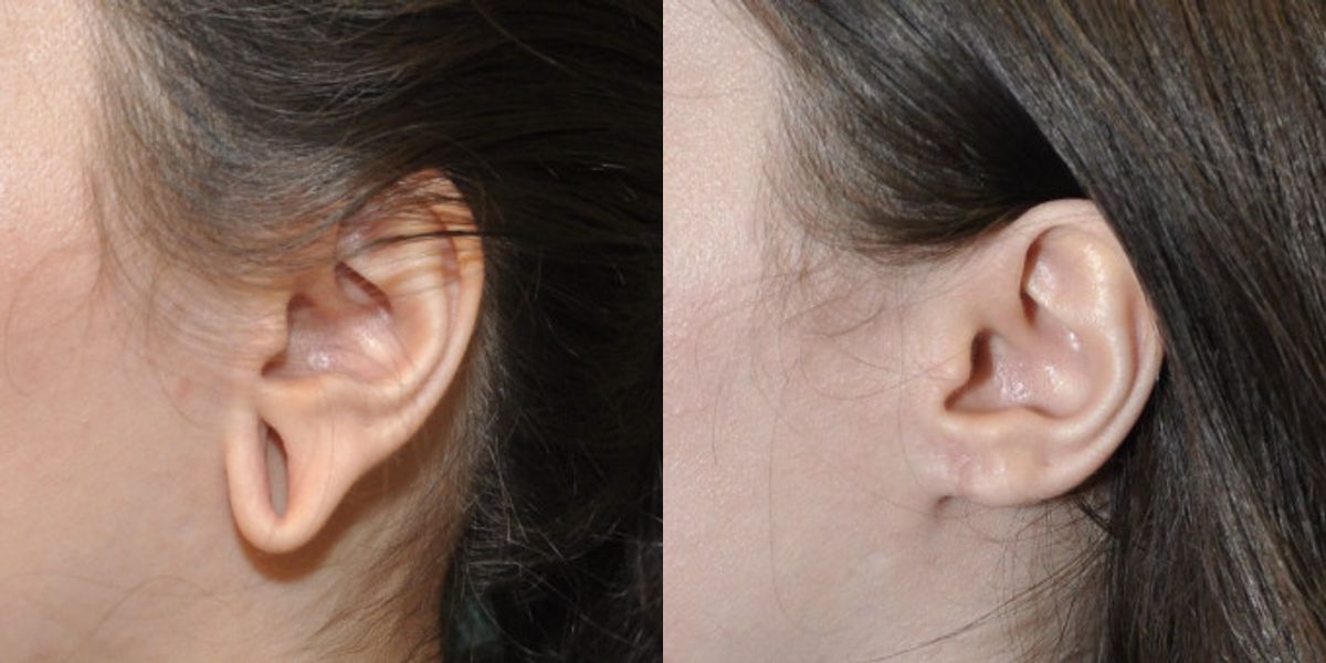Earlobe Repair #8 - Before and After