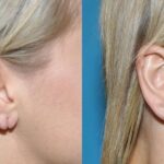 Earlobe Repair #9 - Before and After