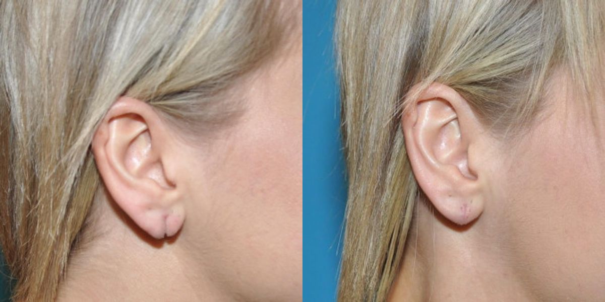Earlobe Repair #9 - Before and After