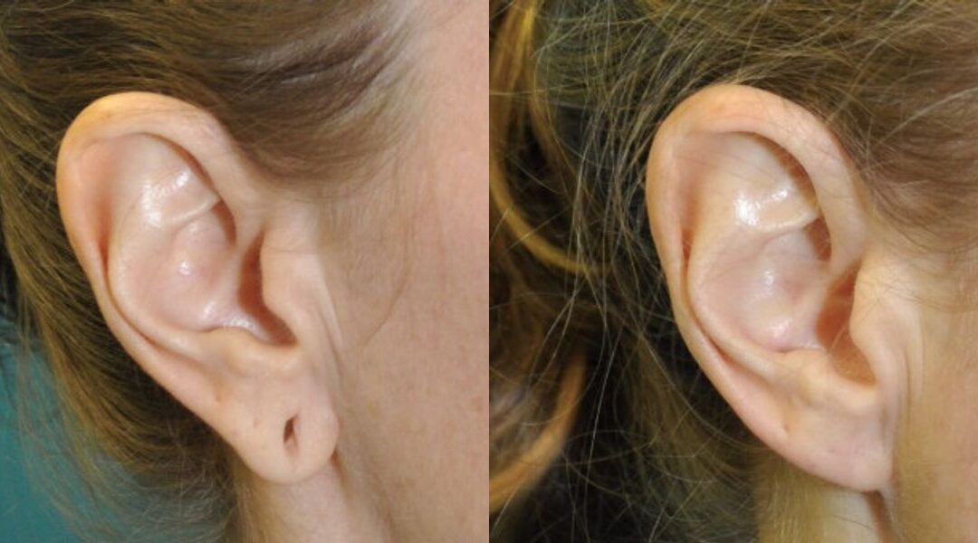 Earlobe Repair #10