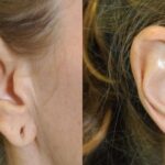 Earlobe Repair #10 - Before and After