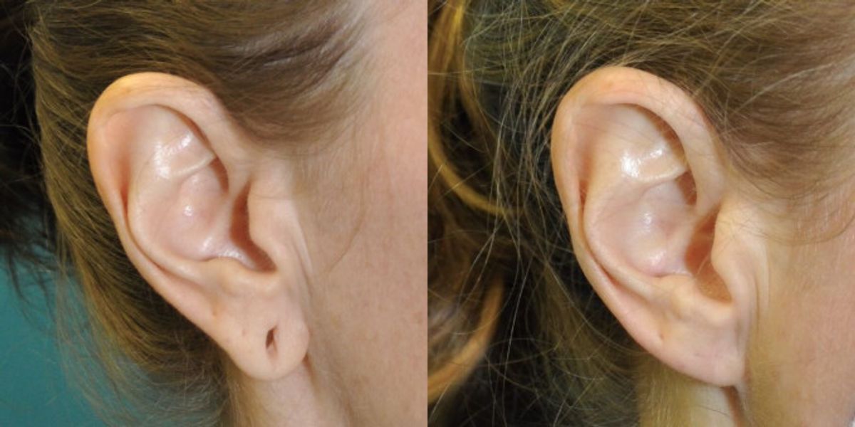 Earlobe Repair #10 - Before and After