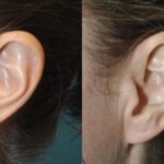 Earlobe Repair #10 - Before and After