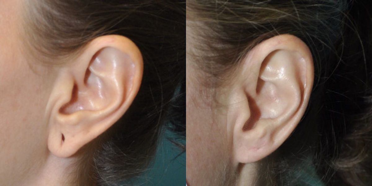Earlobe Repair #10 - Before and After