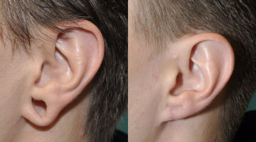Earlobe Repair #11