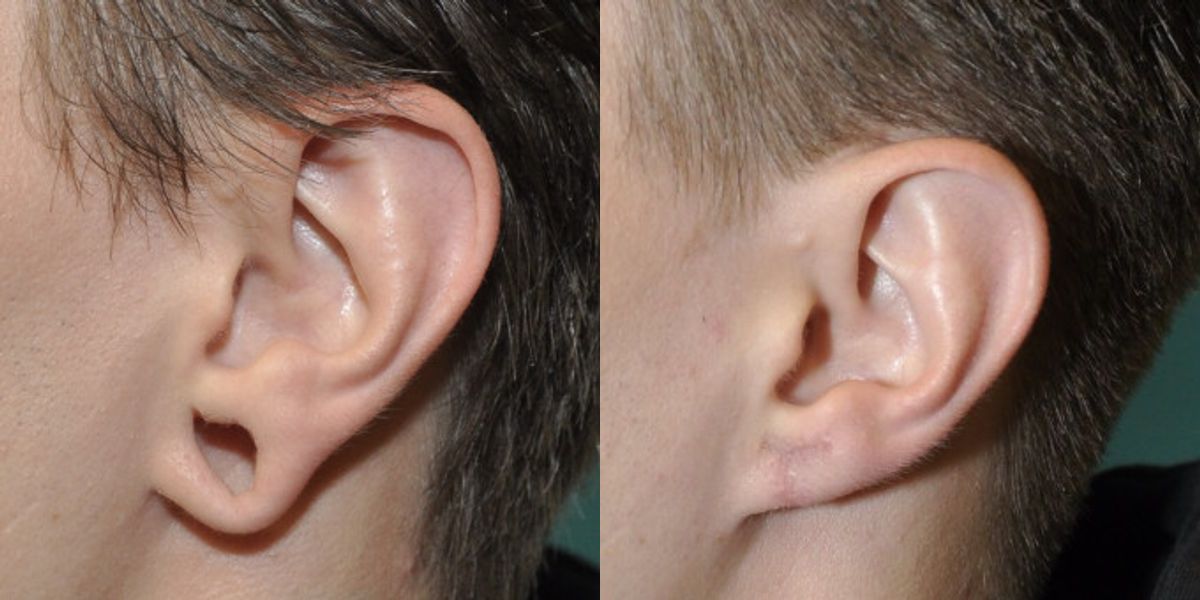 Earlobe Repair #11 - Before and After