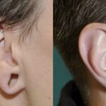 Earlobe Repair #11 - Before and After