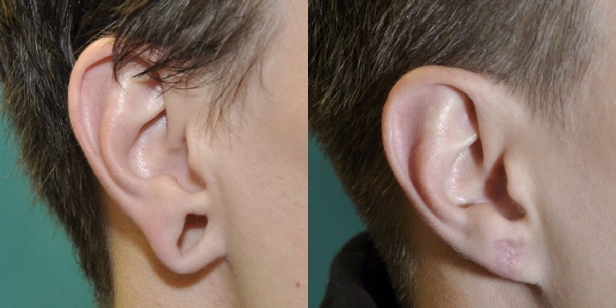 Earlobe Repair #11 - Before and After