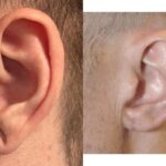 Earlobe Repair #12 - Before and After