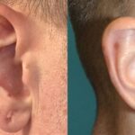 Earlobe Repair #12 - Before and After