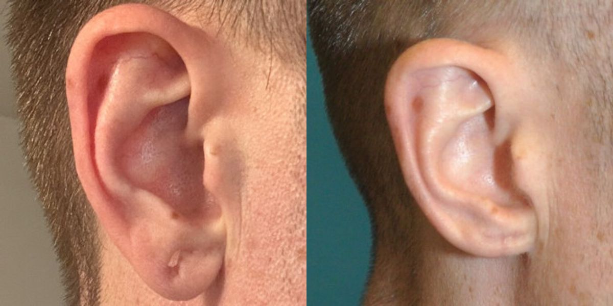 Earlobe Repair #12 - Before and After