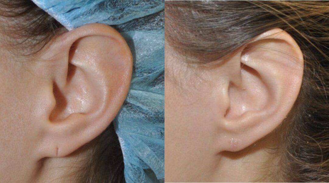 Earlobe Repair #13