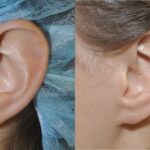 Earlobe Repair #13 - Before and After