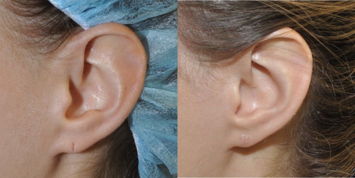 Earlobe Repair #13 - Before and After