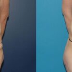 Extended Abdominoplasty and Arm Lift - Before and After
