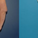 Extended Abdominoplasty and Arm Lift - Before and After