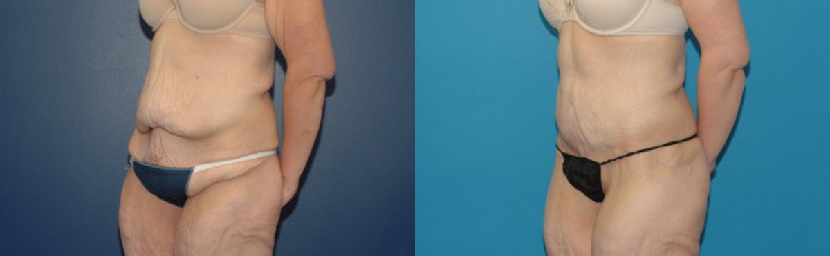 Extended Abdominoplasty and Arm Lift - Before and After