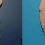 Extended Abdominoplasty and Arm Lift - Before and After