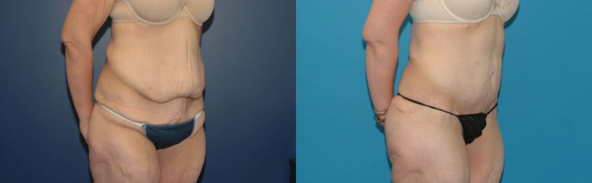 Extended Abdominoplasty and Arm Lift - Before and After