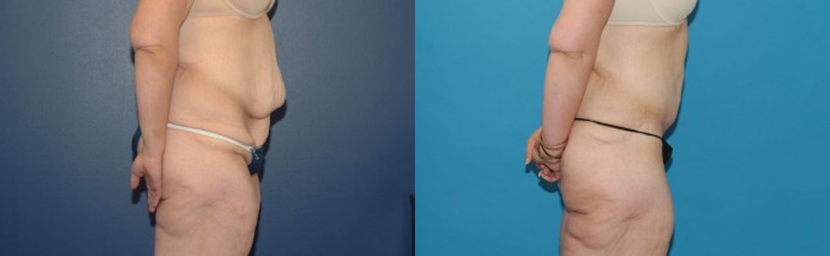 Extended Abdominoplasty and Arm Lift - Before and After