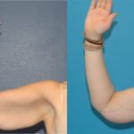 Extended Abdominoplasty and Arm Lift - Before and After