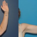 Extended Abdominoplasty and Arm Lift - Before and After