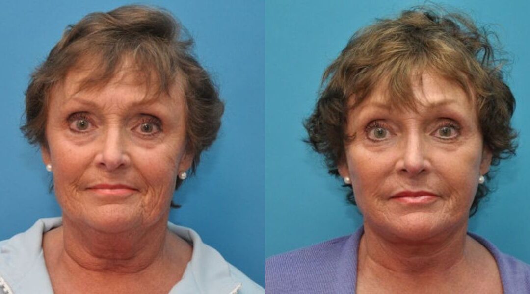 Face and Neck Lift # 1