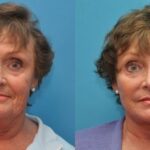 Face and Neck Lift # 1 - Before and After