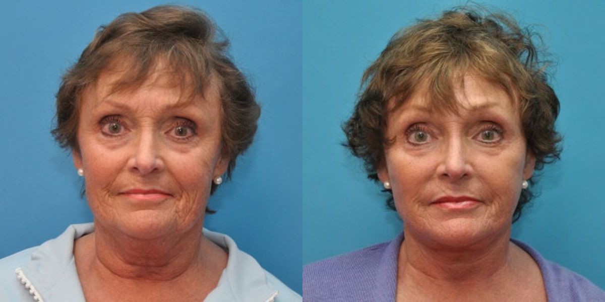 Face and Neck Lift # 1 - Before and After