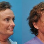 Face and Neck Lift # 1 - Before and After