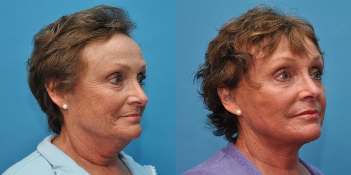 Face and Neck Lift # 1 - Before and After